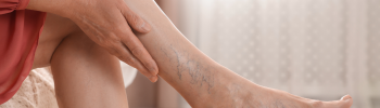 Fisioterapia en a trombosis: tratamiento linfático Fisioterapia en a trombosis: tratamiento linfático