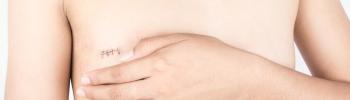 Fisioterapia y control del linfedema tras mastectomía parcial Fisioterapia y control del linfedema tras mastectomía parcial