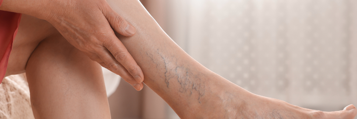 Fisioterapia en a trombosis: tratamiento linfático