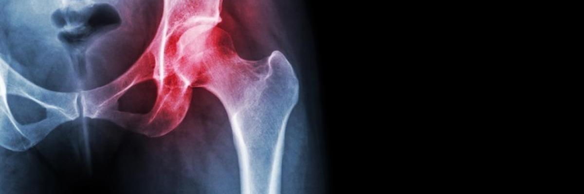 Necrosis avascular de la cadera: fisioterapia y ondas de choque - FisioClinics Sabadell