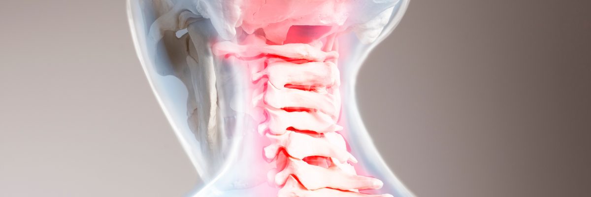 Terapia miofascial para el tratamiento de la cervicalgia