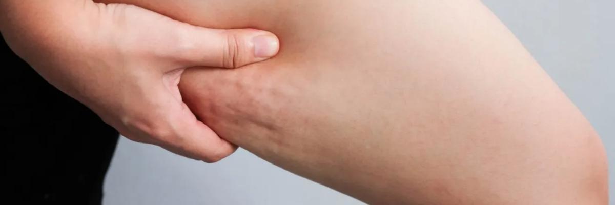 ¿Por qué se forma la celulitis y cómo reducirla? - FisioClinics Sabadell