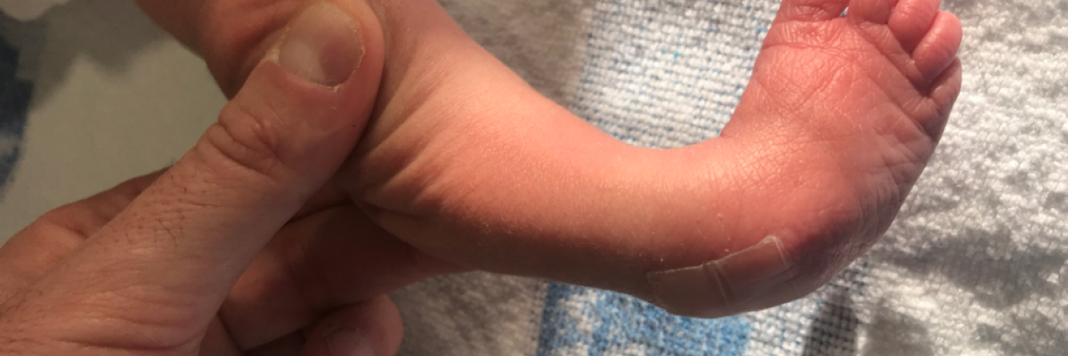 Fisioterapia infantil para pie equino en recién nacidos