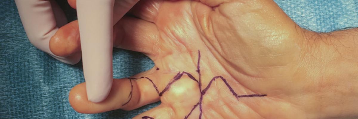 Recuperación tras fasciectomía de palma con fisioterapia manual